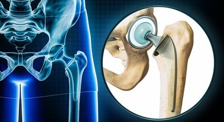 Hip Replacement Surgery in Ghaziabad