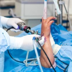 Group of orthopedic surgeons performing a wrist arthroscopy on a male patient